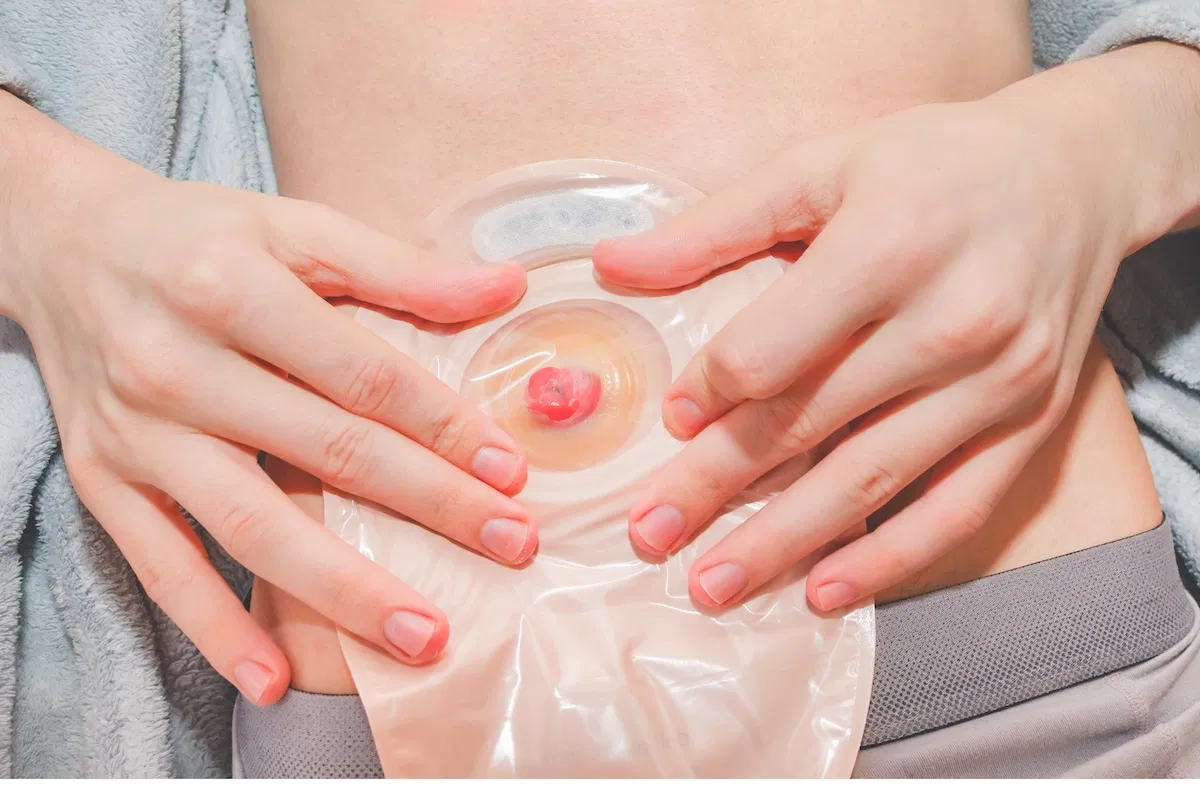 Associacao dos ostomizados de leme